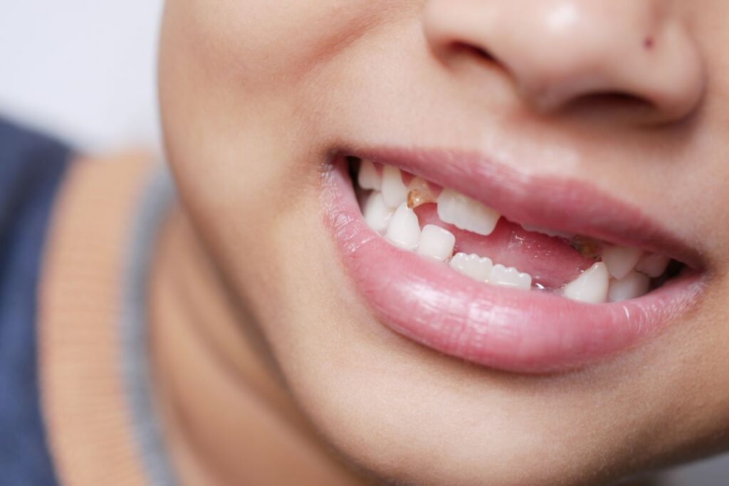 Detailed image showing a child's mouth with missing teeth, capturing a youthful smile.