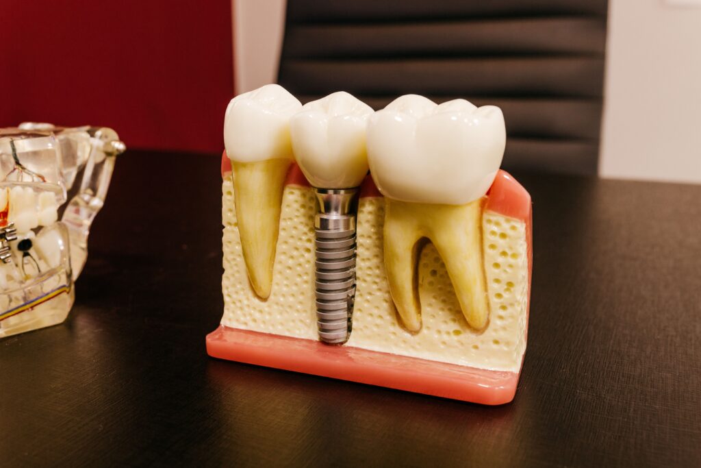 zubní implantace