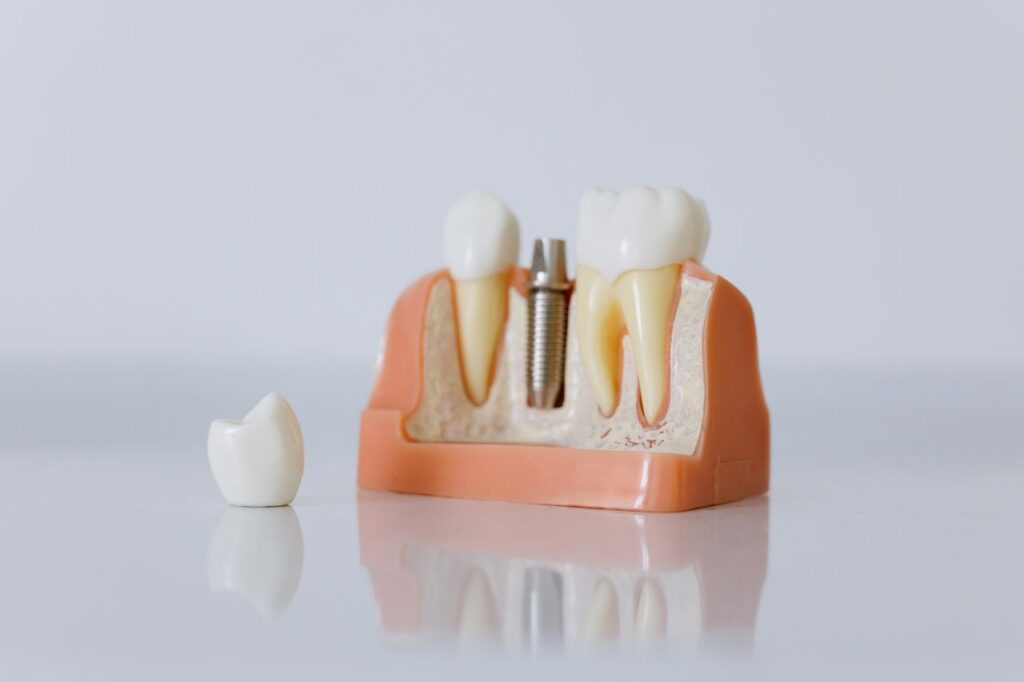 Close-up of a dental implant model featuring artificial teeth and jaw structure.